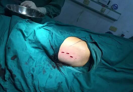 深圳雪象医院运用微创手术又治愈一例股骨转子间骨折